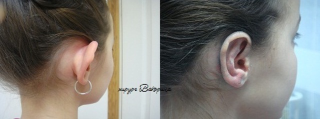 Мне делали операцию по корекции ушей
