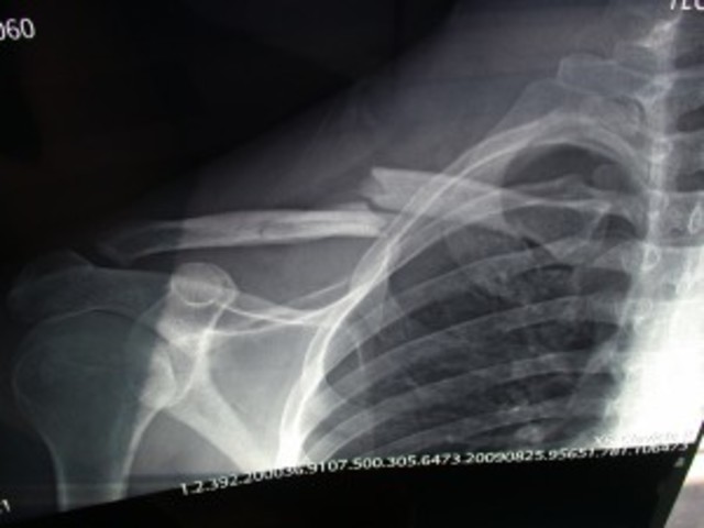 Broke my collar bone