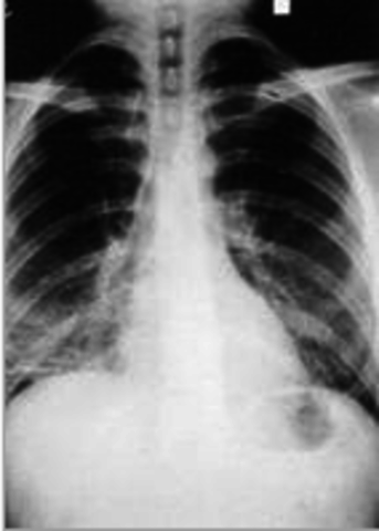 The First Case of HIV in US