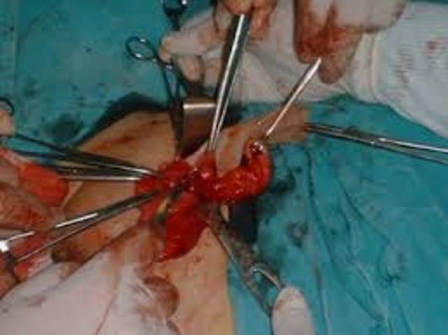 The first performed appendectomy takes place.