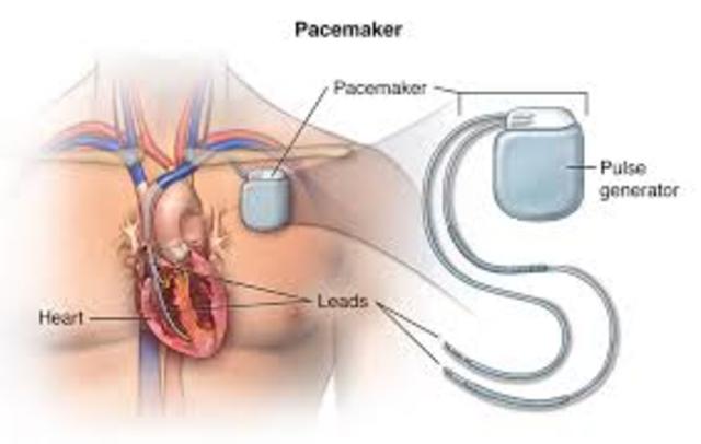 The first instellation of the pacemaker occurs.