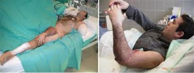 The first performed re-attachment surgery that was sucessful.