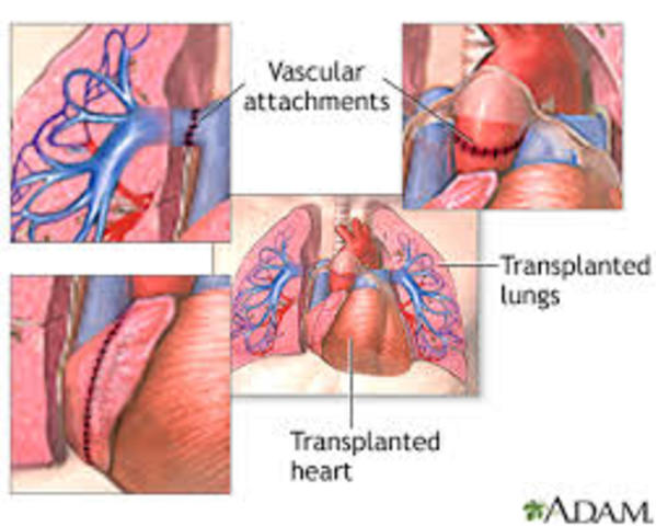 The first lung and heart transplant takes place.