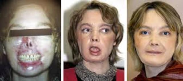 First face transplant surgery.