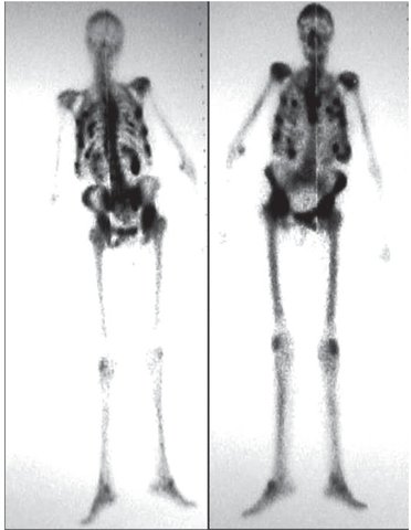 Construcción del Scanner con cristal de centelleo de yoduro sódico, que permite realizar las primeras gammagrafías
