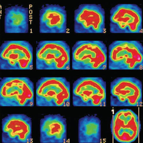 Aparicion del SPECT - PET