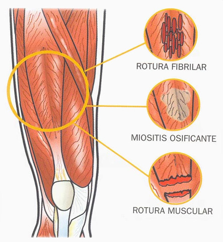 Rotura del aduptor en el primer año juvenil de fútbol
