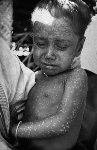 immunisation of small pox