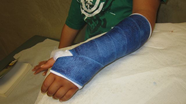i break my arm