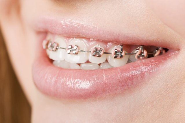 Top Braces