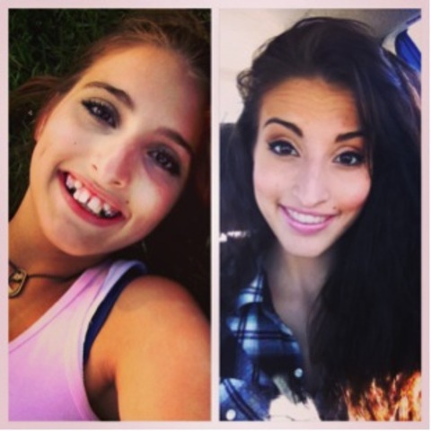 Last Day With Braces