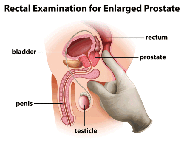 Start Prostate exam
