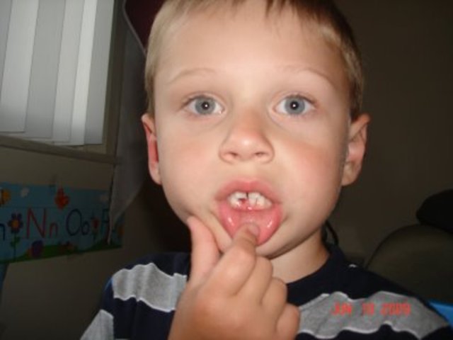 physocal development of 6 year old