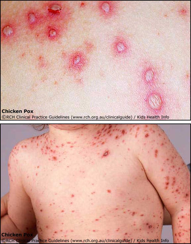 Chicken Pox