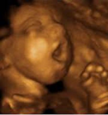 semana trigecima quinta de gestación