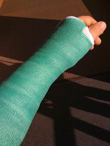 Broken Arm
