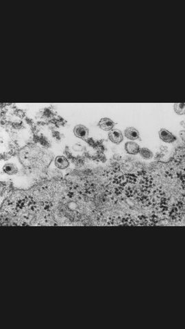 1st known outbreak of aids in u.s