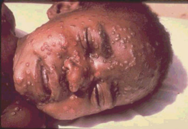 Smallpox Outbreak in Brazil