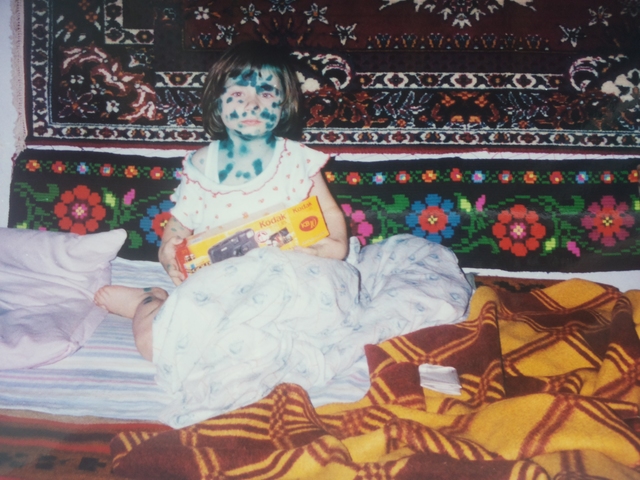 Ветренная оспа