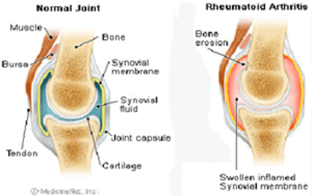 Develops chronic rheumatoid arthritis