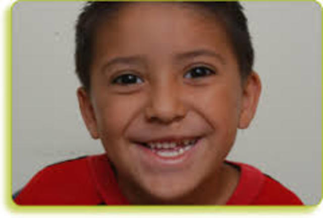 Hassans Cleft Lip was fixed