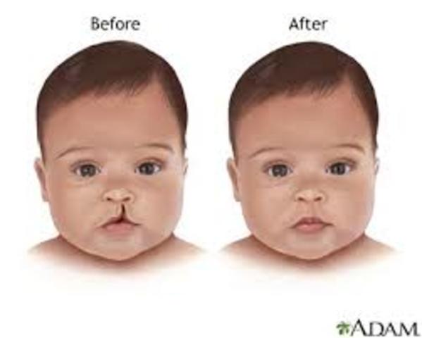 surgery for Hassan's cleft lip