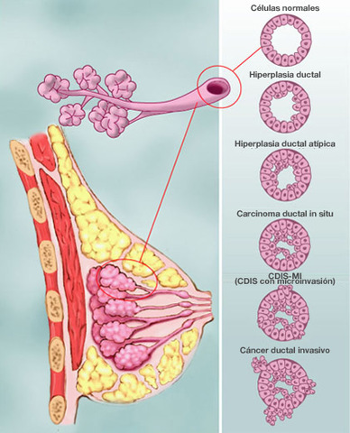 HIPERPLASIA DUCTAL ATIPITCA