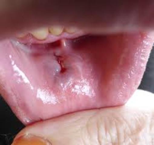 Mes dents sont passés par ma lèvre. Je devais obtenir des points dans ma lèvre inférieure. Il y avait beaucoup de sang.