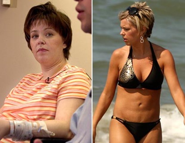 Kate gets free tummy tuck