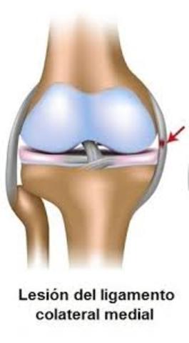 Rotura parcial de ligamento colateral medial rodilla derecha