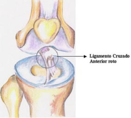 Rotura ligamento cruzado anterior, rodilla derecha