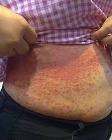 PRIMER CASO DE CHIKUNGUNYA