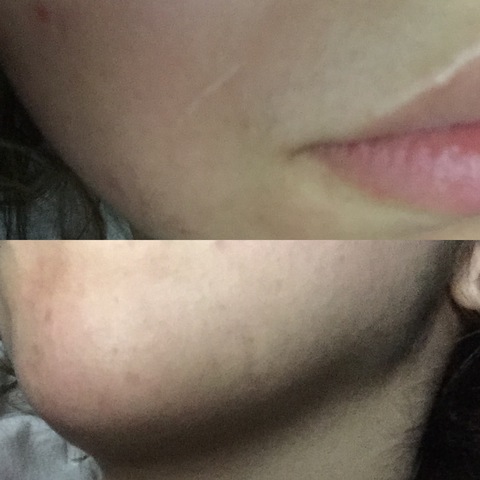 Duke attacted me and bit my face