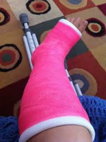Broken Ankle