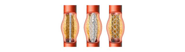Percutane coronaire angioplastiek