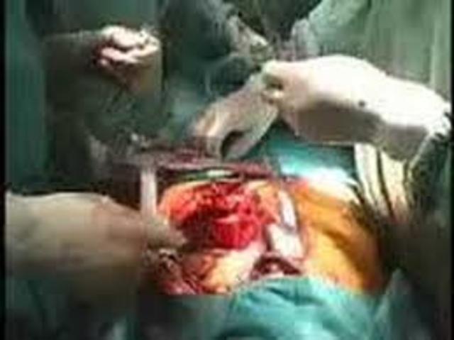 primer transplante de corazón