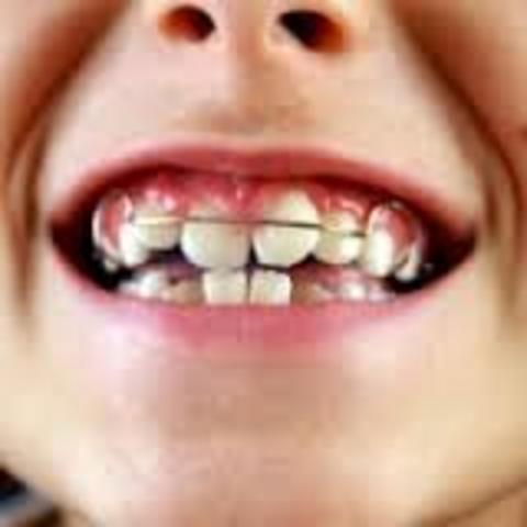 Brackets / Cambio de escuela