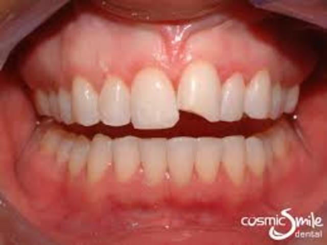 Chipped a tooth