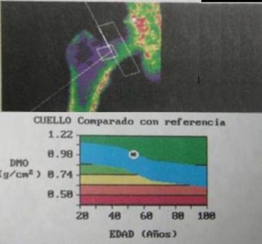 densitometria osea