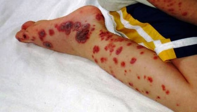 Notificacion de la enfermedad como transmision