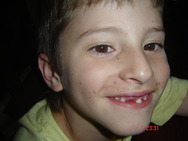 my first falled tooth