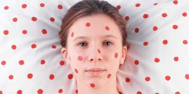 ULTIMO DE CASO DE VIRUELA EN EL MUNDO