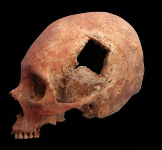 Trepanacion