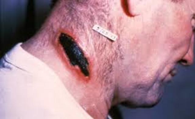 SE DESCUBRE QUE EL ANTRAX ES CAUSADO POR BACILIUS ANTHRACIS