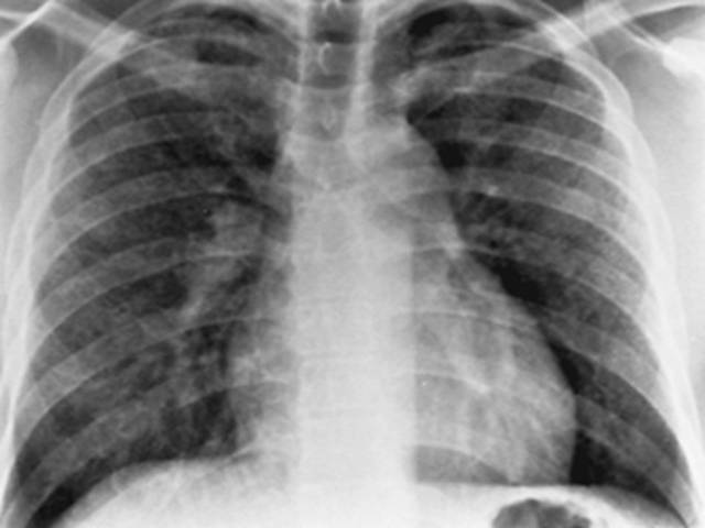 La neumonía atípica