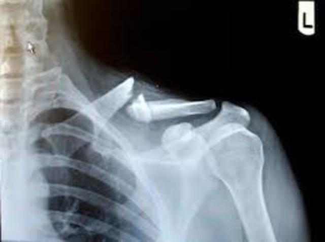 Broke clavical