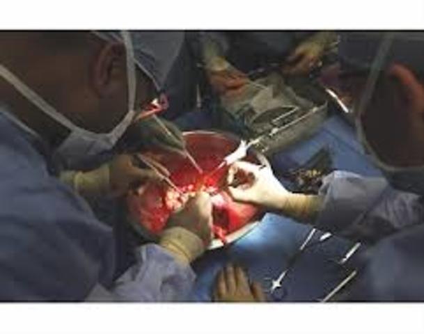 Transplante de Nervios