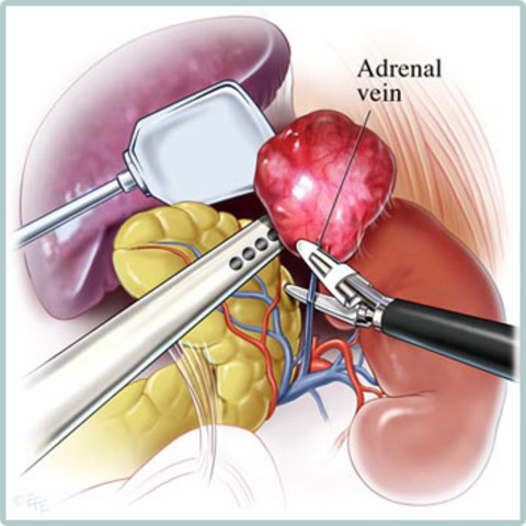 Adrenalectomia