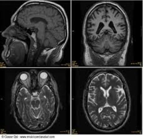 Imagen por resonancia magnética