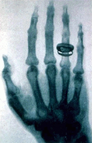 Discovery of X-rays by Wilhelm Roentgen